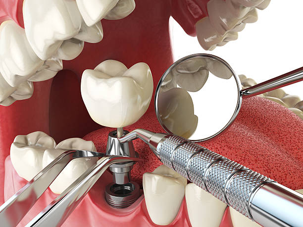 Best Emergency Dentist for Lost Fillings or Crowns in Velva, ND